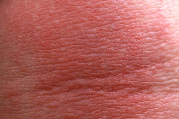 5 Things You Can Do to Control Atopic Dermatitis - DK Glowy