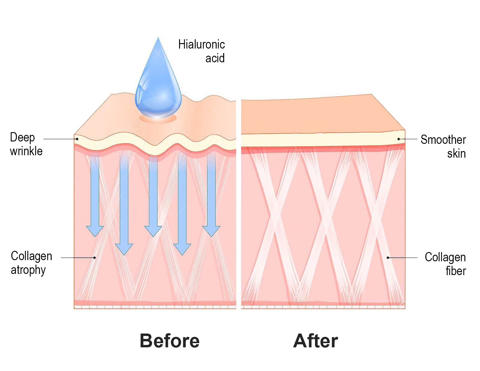 effects of hyaluronic acid