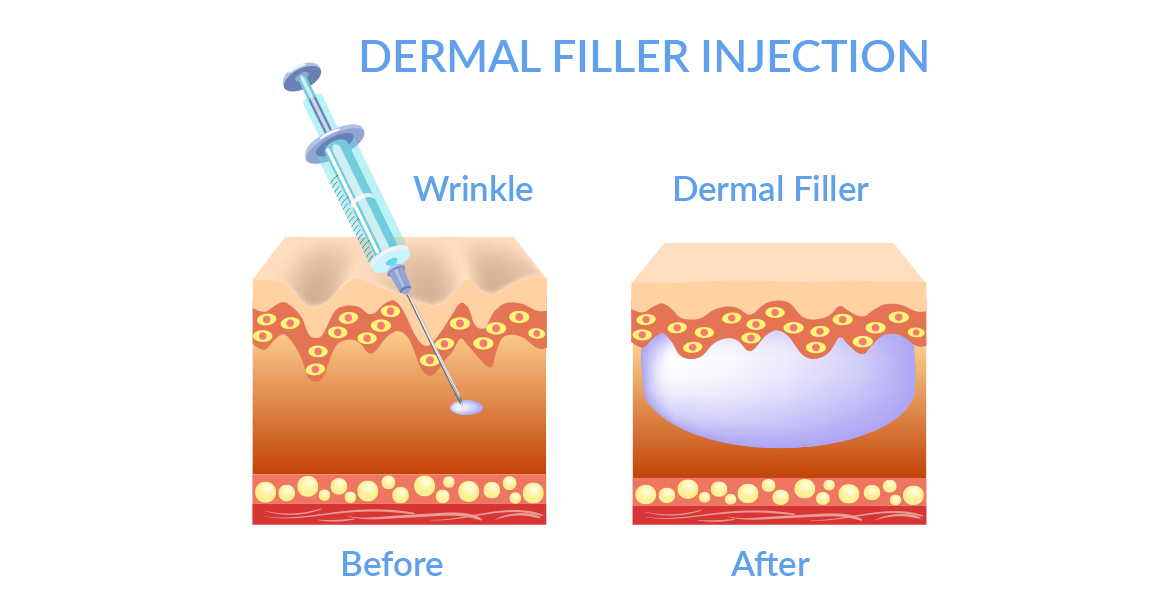 how a dermal filter works